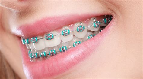 metal braces & brackets|metal braces for teeth alignment.